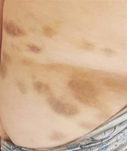 Bruises left by demonic attack